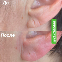 Контурная пластика - восстановление филлером объёма мочки уха. Фото до и сразу после.