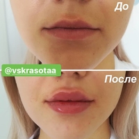Контурная пластика губ. Фото до и сразу после процедуры.
