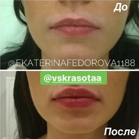 Увеличение губ препаратом на основе гиалуроновой кислоты. Фото до и сразу после процедуры.