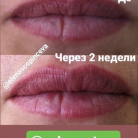 Омоложение губ при помощи препарата на основе гиалуроновой кислоты.