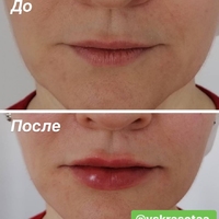 Увеличение губ препаратом на основе гиалуроновой кислоты. До и сразу после.