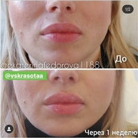 Контурная пластика губ препаратом на основе гиалуроновой кислоты. Фото до и после.