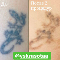 Лазерное удаление татуировки. Фото до и после 2 процедур.