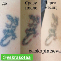 Лазерное удаление татуировки. Фото до, сразу после и через месяц после процедуры.