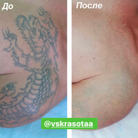 Лазерное удаление татуировки. Фото до и после 7 процедур.