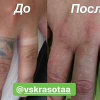 Лазерное удаление татуировки. Фото до и после 6 процедур.